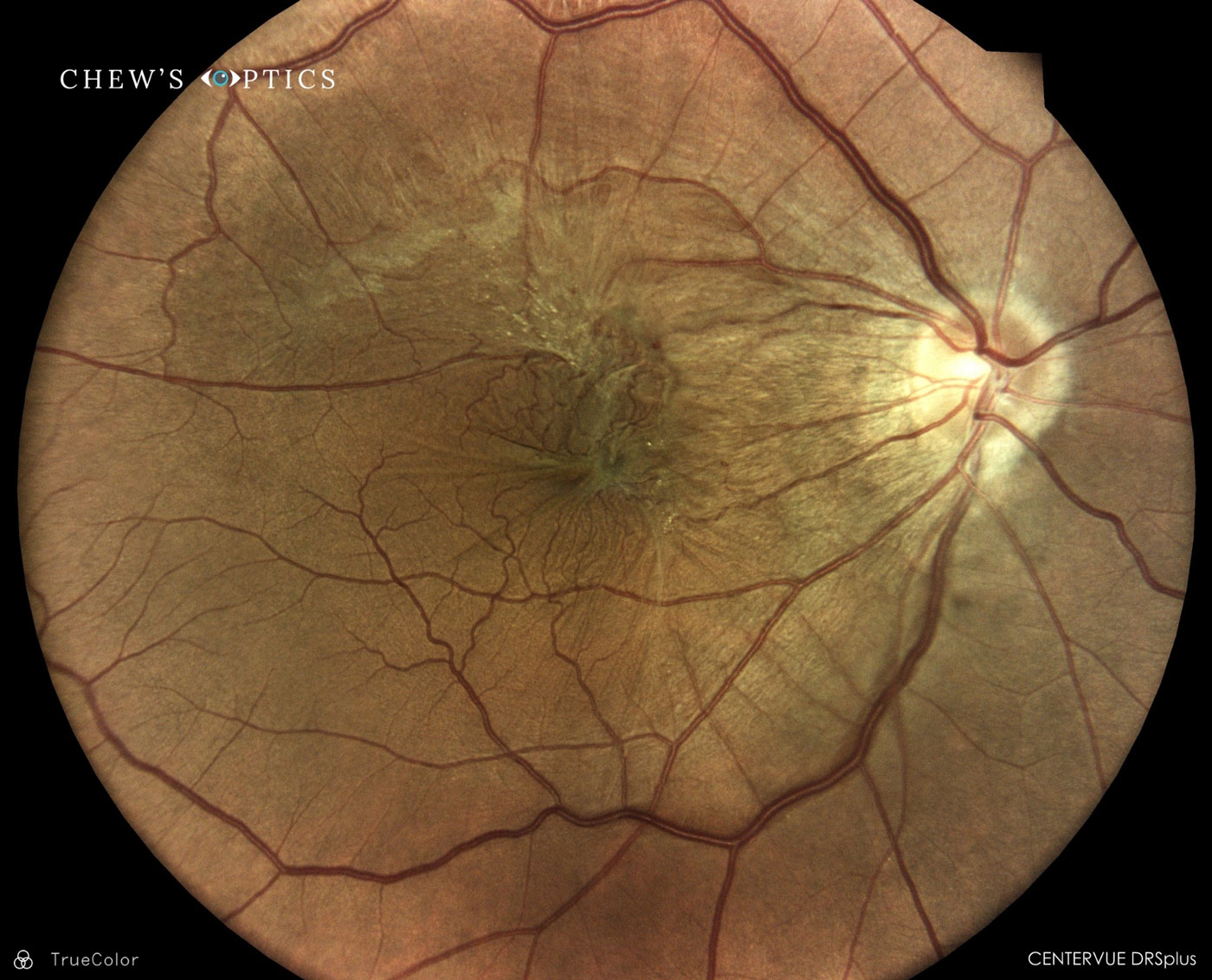 normal retina exam feathre macula